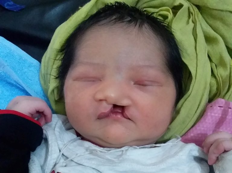 Baby with cleft lip